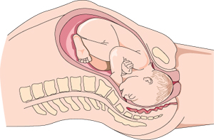 Diagram of a baby in the birth canal.