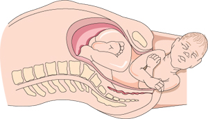 Diagrama del bebé en el canal de parto coronando.