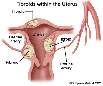 Diagram showing fibroids on the uterus